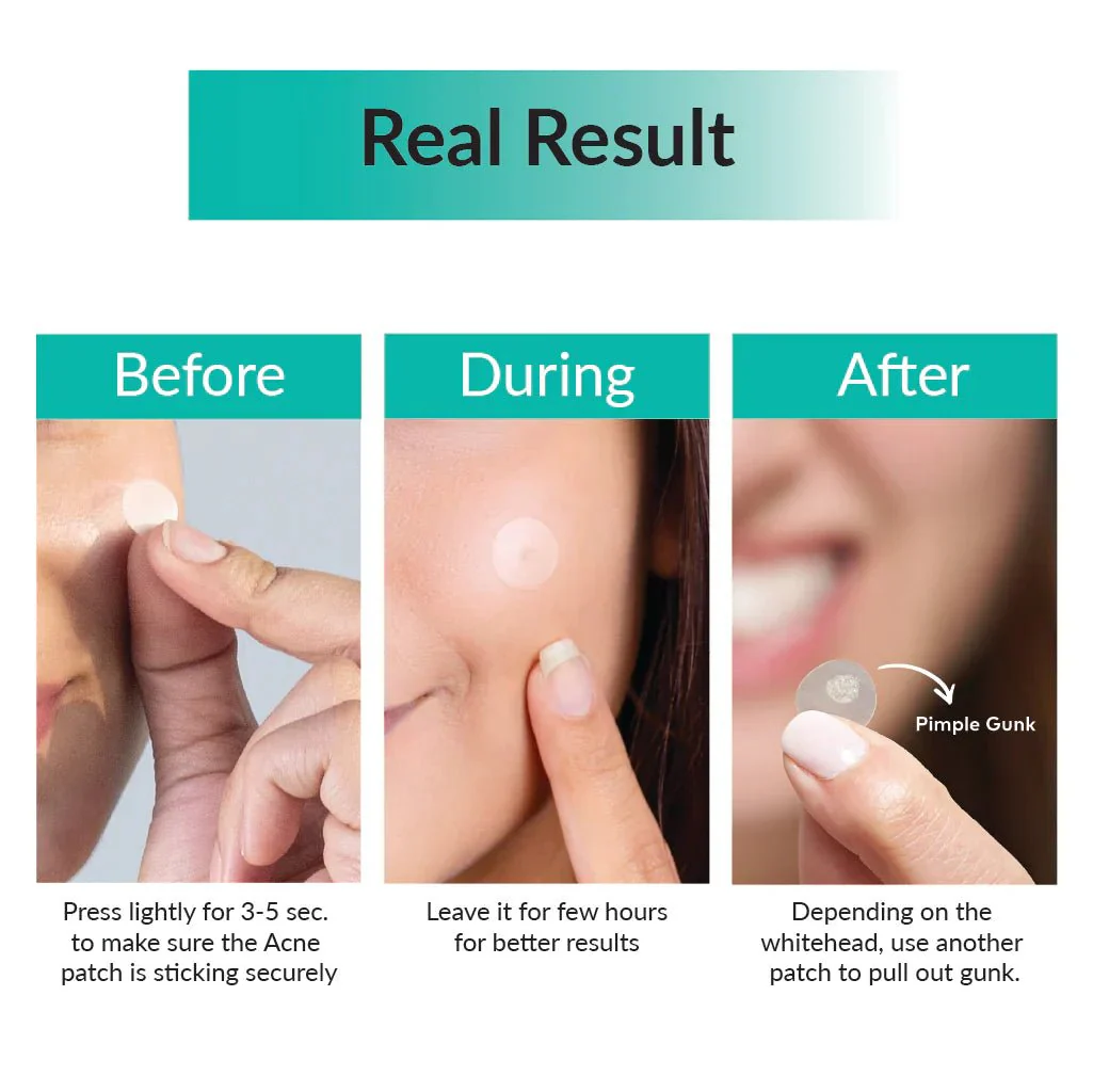 30 Days Miracle Clear Spot Patch [18 pcs] - Image 4